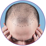 Hair transplantation